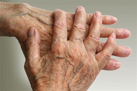 Things People With Rheumatoid Arthritis Want You To Know Page