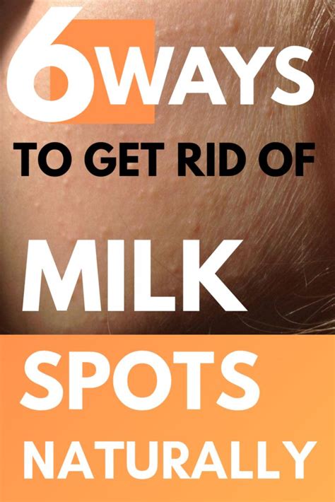 6 Ways To Get Rid Of Milk Spots Naturally With Love And Beauty Visit