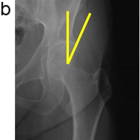 Anteroposterior Radiograph Of The Hip Joint And Measurement Of The