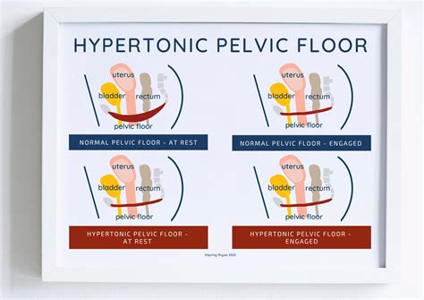 Hypertonic Pelvic Floor Poster Etsy Hot Sex Picture