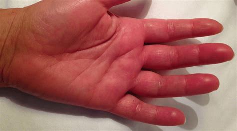 Causes Of Swelling In The Fingers