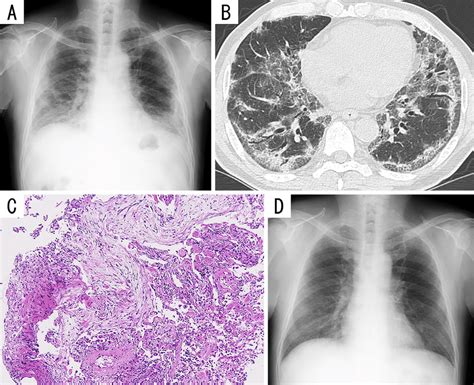 Figure2imaging And Pathological Findings Of Patient 2 A Chest