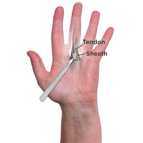 What Are The Surgery Options To Treat My Trigger Finger Trigger