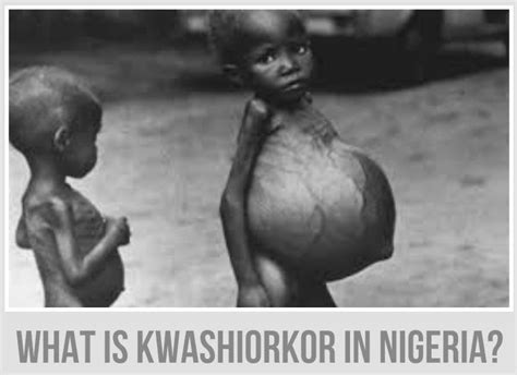 Diagram Of A Child Suffering From Kwashiorkor Askworksheet