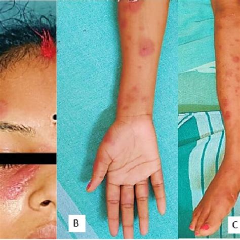 A B And C Erythematous Edematous Tender Plaques Of Variable Sizes