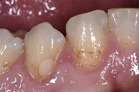 Replacing Old Fillings With Invisible Composite Resin