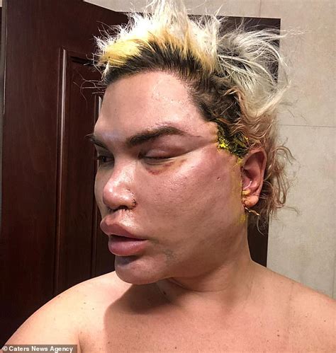 Botox cosmetic injections (botulinum toxin type a) can also help elevate the height of your eyebrows. 'Human Ken Doll' Rodrigo Alves EXCL: Star undergoes ...