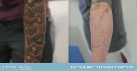 Before and after see more ». PicoSure® Tattoo Removal UK | Andrea Catton Laser Clinic ...