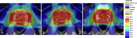 Adaptive Magnetic Resonance Guided Neurovascular Sparing Radiotherapy