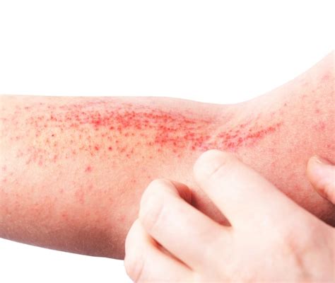Dermatite Atopica cos è perché si manifesta sintomi e cure