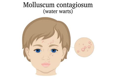 Molluscum Contagiosum Symptoms Causes And Treatments Activebeat