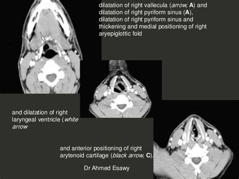 Larynx Imaging 4th Part Virtual Laryngoscopy Vocal Cord Paralysis Ct