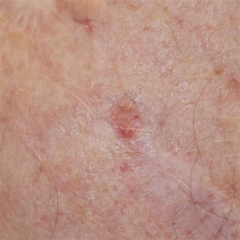 What Does Early Stage Basal Cell Carcinoma Look Like Common Types Of