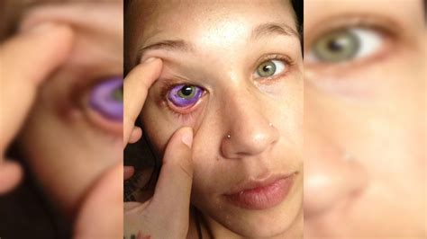 Harassed On Social Media Ottawa Woman Vows To ‘keep Promoting Awareness On Eyeball Tattoos