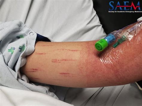 Saem Clinical Image Series Rash With Blood Pressure Cuff Inflation