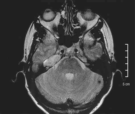 Radiology Quiz Case 1 Radiology Jama Otolaryngologyhead And Neck Surgery Jama Network