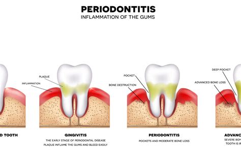 What Are The Signs And Symptoms Of Periodontal Disease Implant