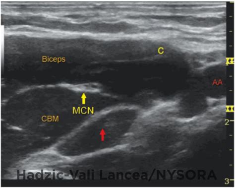 Ultrasound Guided Axillary Brachial Plexus Block Nysora The New York