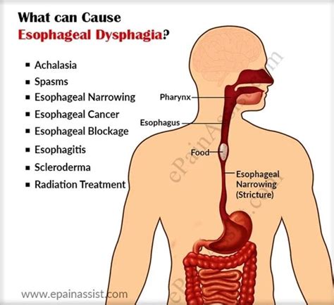 What Causes Dysphagia And How Is It Diagnosed And Treated Dysphagia