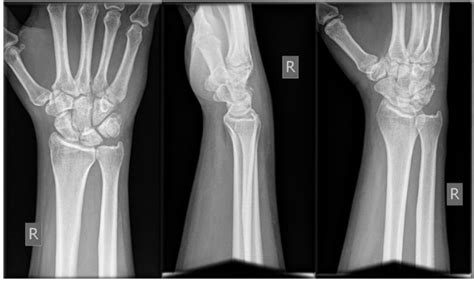 Intra Articular Fracture Of The Distal Part Of The Triquetrum Within