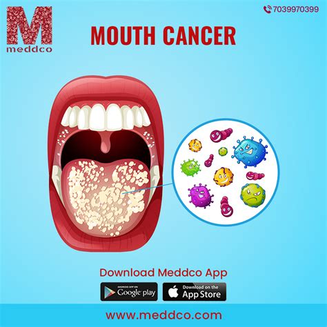 Mouth Cancer Symptoms Diagnosis And Treatment