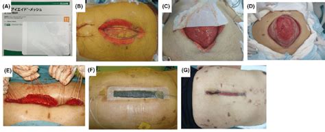 There is the physical size of the yolks in amongst the organs, not to mention the inflammation that goes with it and the sometimes large quantities of fluid present in the abdomen. Open abdomen management for treatment of peritonitis in a ...