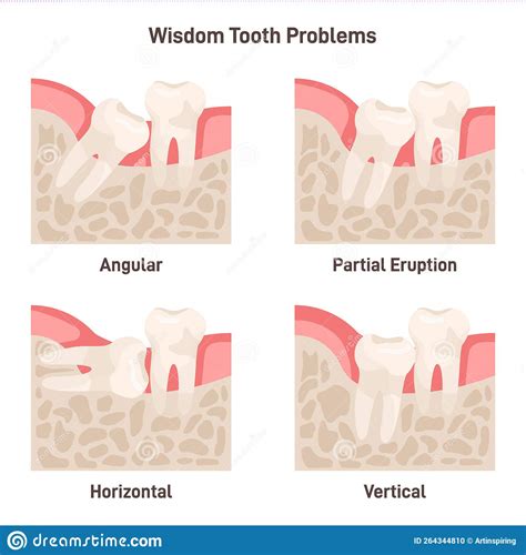 Wisdom Tooth Problems Set Impaction Wisdom Teeth Growing With Wrong
