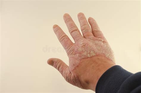 Psoriasis On The Hand Bones Close Up Stock Image Image Of Itching
