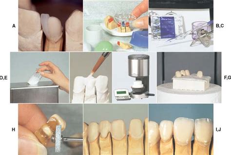 25 All Ceramic Restorations Pocket Dentistry