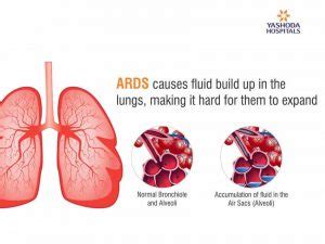 How To Diagnose And Treat Acute Respiratory Distress Syndrome