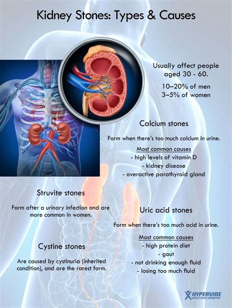 Can Kidney Stones Cause An Infection