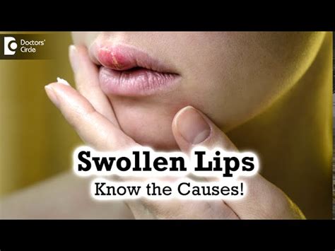 Swollen Lips And Hives Pictures