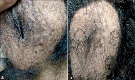 Therapy Recalcitrant Folliculitis Decalvans Controlled Successfully