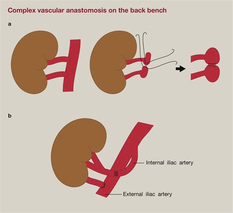 Kidney Transplantation Surgery Oxford International Edition