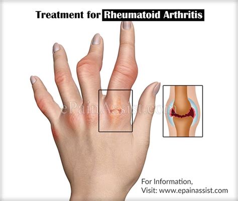 Rheumatoid Arthritis Chronic Inflammation Of Jointssymptoms