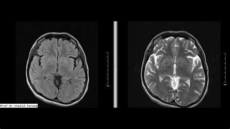 Mri Brain Olivopontocerebellar Atrophy Youtube