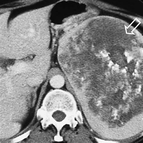 Ct Scan Demonstrating Retroperitoneal Lymph Node Involvement With