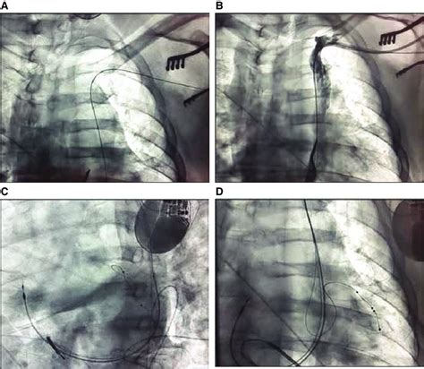 A D Implantation Of A Cardiac Resynchronization Therapy Defibrillator