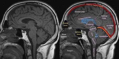 Head And Spine Anatomy Radiology Cafe