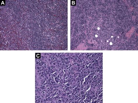 Sequential Occurrence Of A Splenic Marginal Zone Lymphoma Extranodal