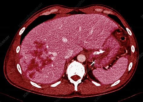 Liver Contusions Ct Scan Stock Image C0353591 Science Photo Library