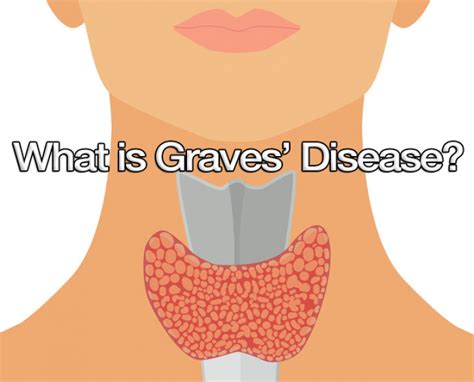What Is Graves Disease Thyroid Advisor