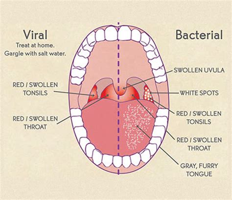 Cigarette Sore Throat Spots White Tonsils Pictures Your 2dd