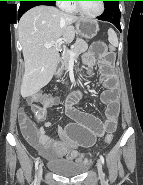 Small Bowel Obstruction Sbo With Stricture On The Terminal Ileum In A