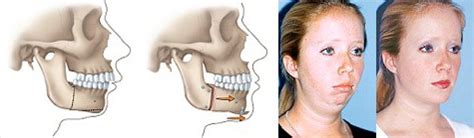 Corrective Jaw Surgery Sydney Orthognathic Surgery