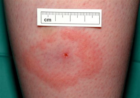 Tick Bite And Early Lyme Borreliosis The Bmj