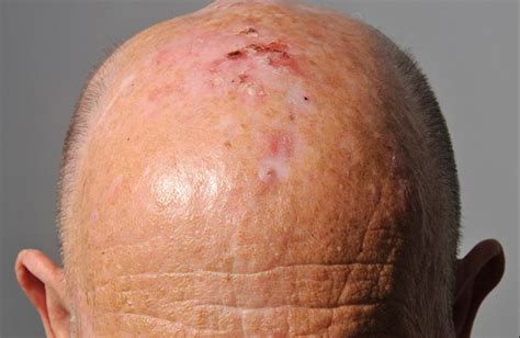 Non Surgical Management Of Actinic Keratosis Bowens Disease And Non