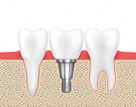 Implante Humano Dental Dental Humano Médico Implante Dental Diente
