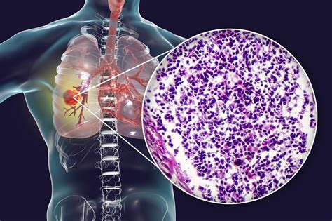 Estadísticas del cáncer de pulmón de células pequeñas ZenOnco io