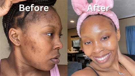 How I Cleared My Acne Dark Spots Hyperpigmentation For Good In 1